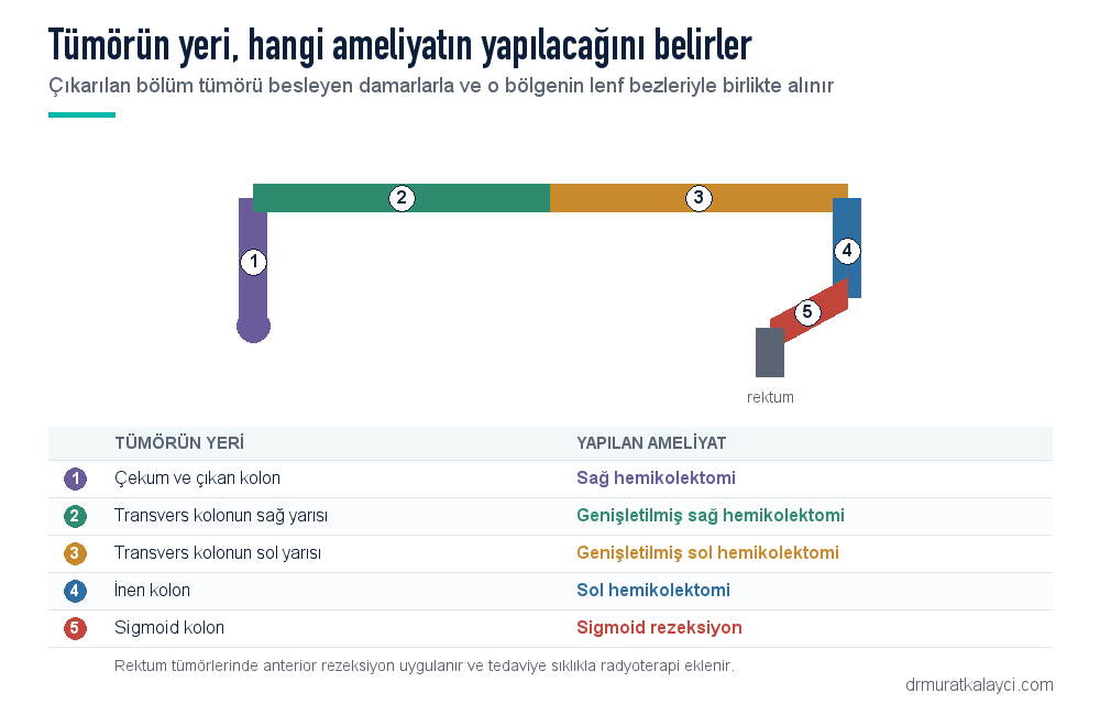 Kolon kanserinde tümörün yerine göre yapılan ameliyatlar: sağ hemikolektomi, genişletilmiş sağ ve sol hemikolektomi, sol hemikolektomi, sigmoid rezeksiyon