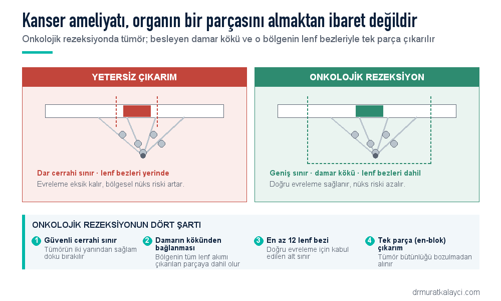 Onkolojik rezeksiyonun dört şartı: güvenli cerrahi sınır, damarın kökünden bağlanması, en az 12 lenf bezi ve tek parça en-blok çıkarım