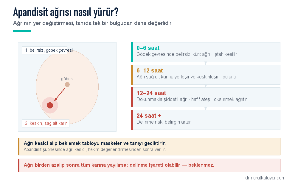 Apandisit ağrısının göbek çevresinden sağ alt karına göçü ve saat saat seyri: 0-6 saat belirsiz ağrı, 6-12 saat sağ alt karına yerleşme, 12-24 saat dokunmakla şiddetli ağrı, 24 saat sonrası delinme riski