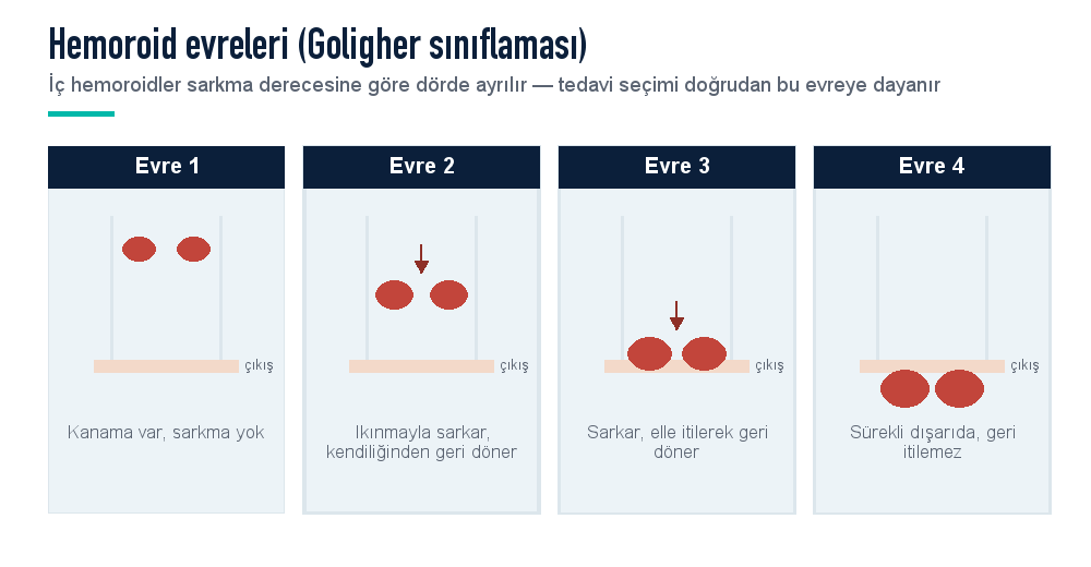 Hemoroid evreleri: Evre 1 kanama var sarkma yok, Evre 2 sarkar kendiliğinden geri döner, Evre 3 elle itilerek geri döner, Evre 4 sürekli dışarıda