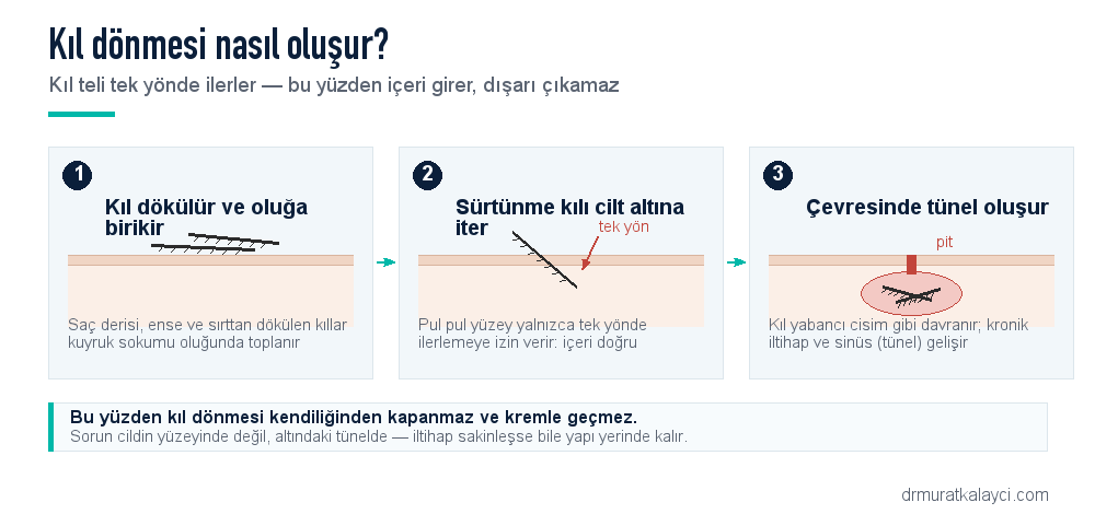 Kıl dönmesi oluşum mekanizması: dökülen kılın pul pul yüzeyi tek yönde ilerlemesine izin verir, sürtünmeyle cilt altına girer, çevresinde kronik iltihap ve tünel oluşur, ciltteki delikler pit adını alır