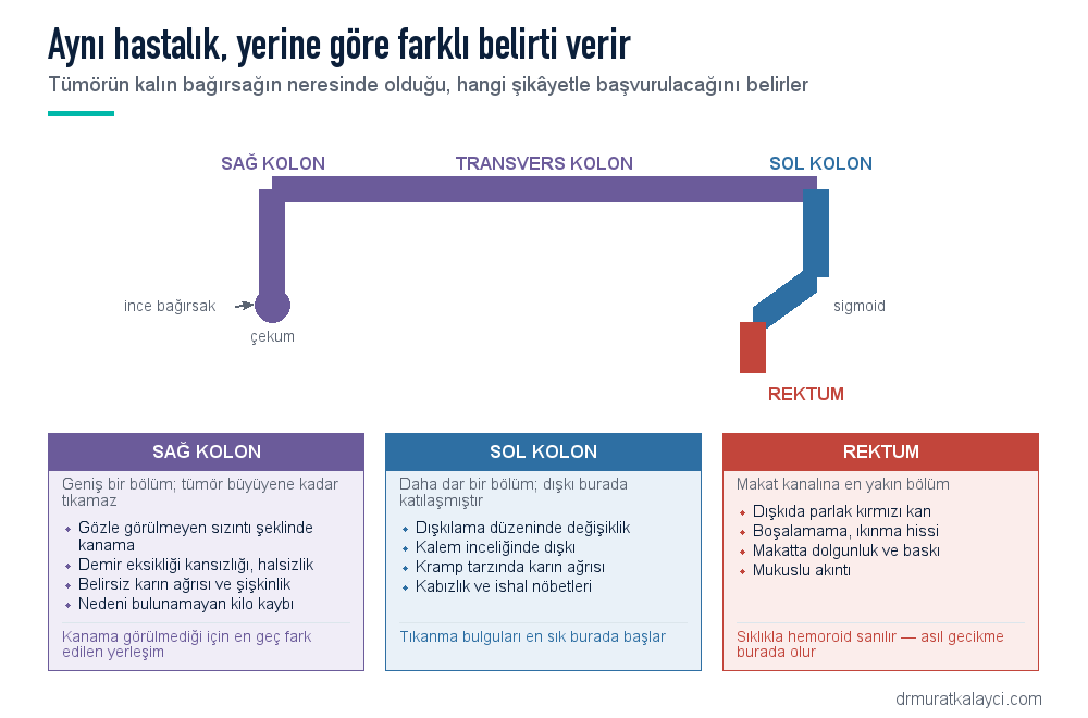 Kolon kanserinde tümörün yerleşimine göre belirtiler: sağ kolonda kansızlık ve gizli kanama, sol kolonda tıkanma ve dışkılama değişikliği, rektumda parlak kanama ve ıkınma hissi